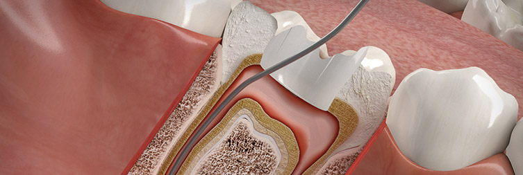 Wurzelbehandlung vom Zahnarzt